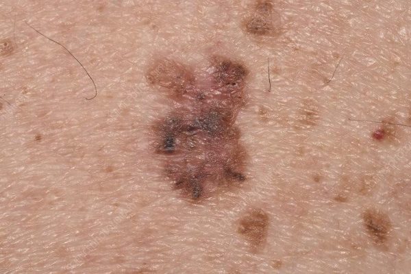 سرطان سلول های پایه (بازال) BCC چیست ؟ - تشخیص و درمان آن - وبلاگ وان طب