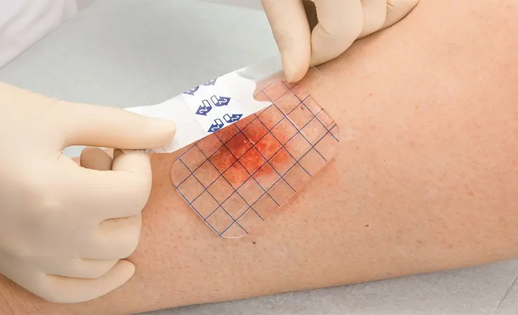 راهنمای کامل پانسمان کلاژن برای زخم‌های ناشی از شیمی‌درمان